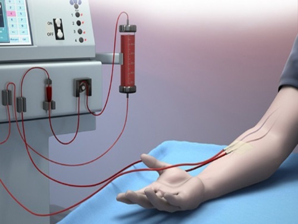 Dialysis (Hemodialysis)